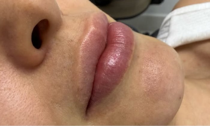 Preenchimento labial, caso 01, início