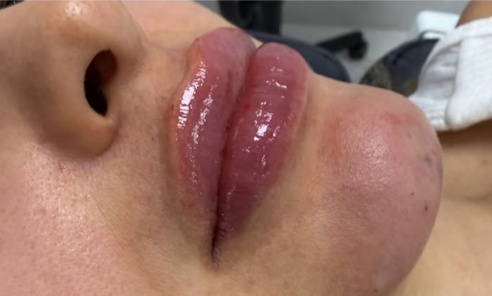 Preenchimento labial, caso 01, resultado
