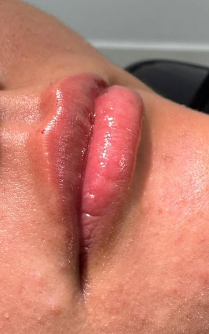 Preenchimento labial, caso 02, resultado