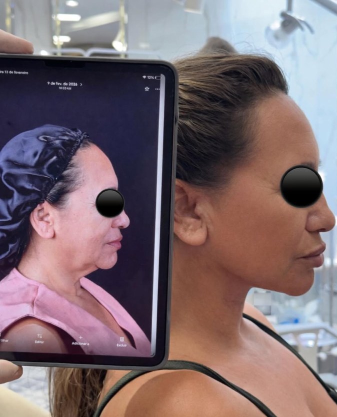 Contorno do pescoço, caso 02: início na tela do tablet e resultado ao lado